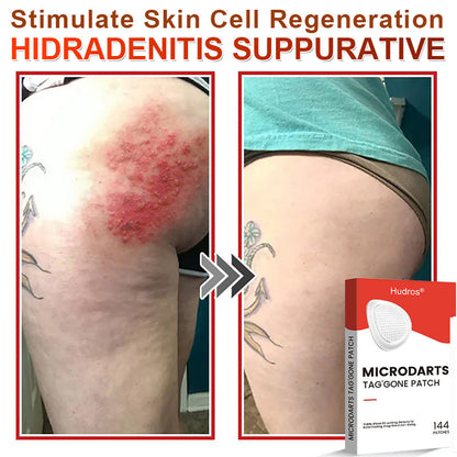 70%📌Hudros® 2-in-1 Microneedle & Hydrocolloid Patch | Raised Moles,Acne,  Flat Warts & Skin Tags Remover | Improves Wrinkles, Scars & Blemishes | Invisible Star Pimple Patches for Face & Body | 144 Count（xy）
