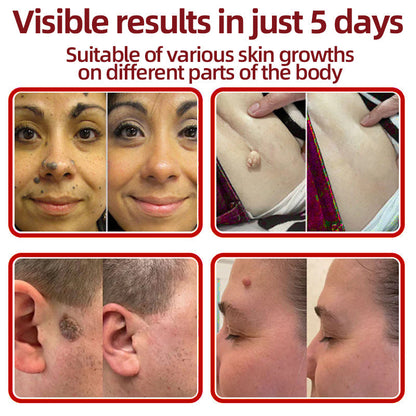 70%📌Hudros® 2-in-1 Microneedle & Hydrocolloid Patch | Raised Moles,Acne,  Flat Warts & Skin Tags Remover | Improves Wrinkles, Scars & Blemishes | Invisible Star Pimple Patches for Face & Body | 144 Count（xy）