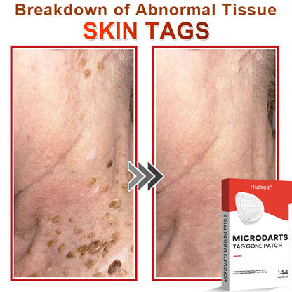 70%📌Hudros® 2-in-1 Microneedle & Hydrocolloid Patch | Raised Moles,Acne,  Flat Warts & Skin Tags Remover | Improves Wrinkles, Scars & Blemishes | Invisible Star Pimple Patches for Face & Body | 144 Count（xy）