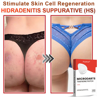 70%📌Hudros® 2-in-1 Microneedle & Hydrocolloid Patch | Raised Moles,Acne,  Flat Warts & Skin Tags Remover | Improves Wrinkles, Scars & Blemishes | Invisible Star Pimple Patches for Face & Body | 144 Count（xy）