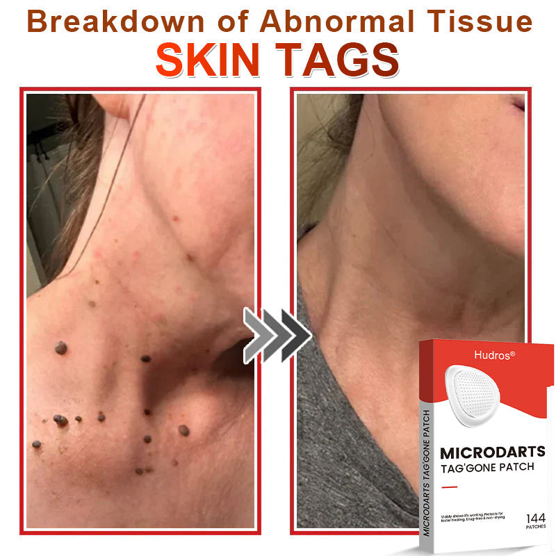 70%📌Hudros® 2-in-1 Microneedle & Hydrocolloid Patch | Raised Moles,Acne,  Flat Warts & Skin Tags Remover | Improves Wrinkles, Scars & Blemishes | Invisible Star Pimple Patches for Face & Body | 144 Count（xy）